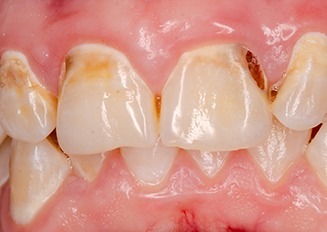 前歯の傾斜
