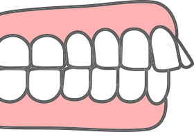 出っ歯(上顎前突)の特徴